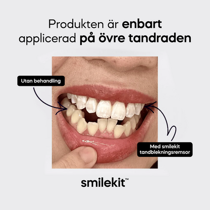 smilekit™ Charcoal Tandblekningsremsor